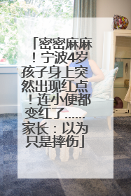 密密麻麻！宁波4岁孩子身上突然出现红点！连小便都变红了……家长：以为只是摔伤